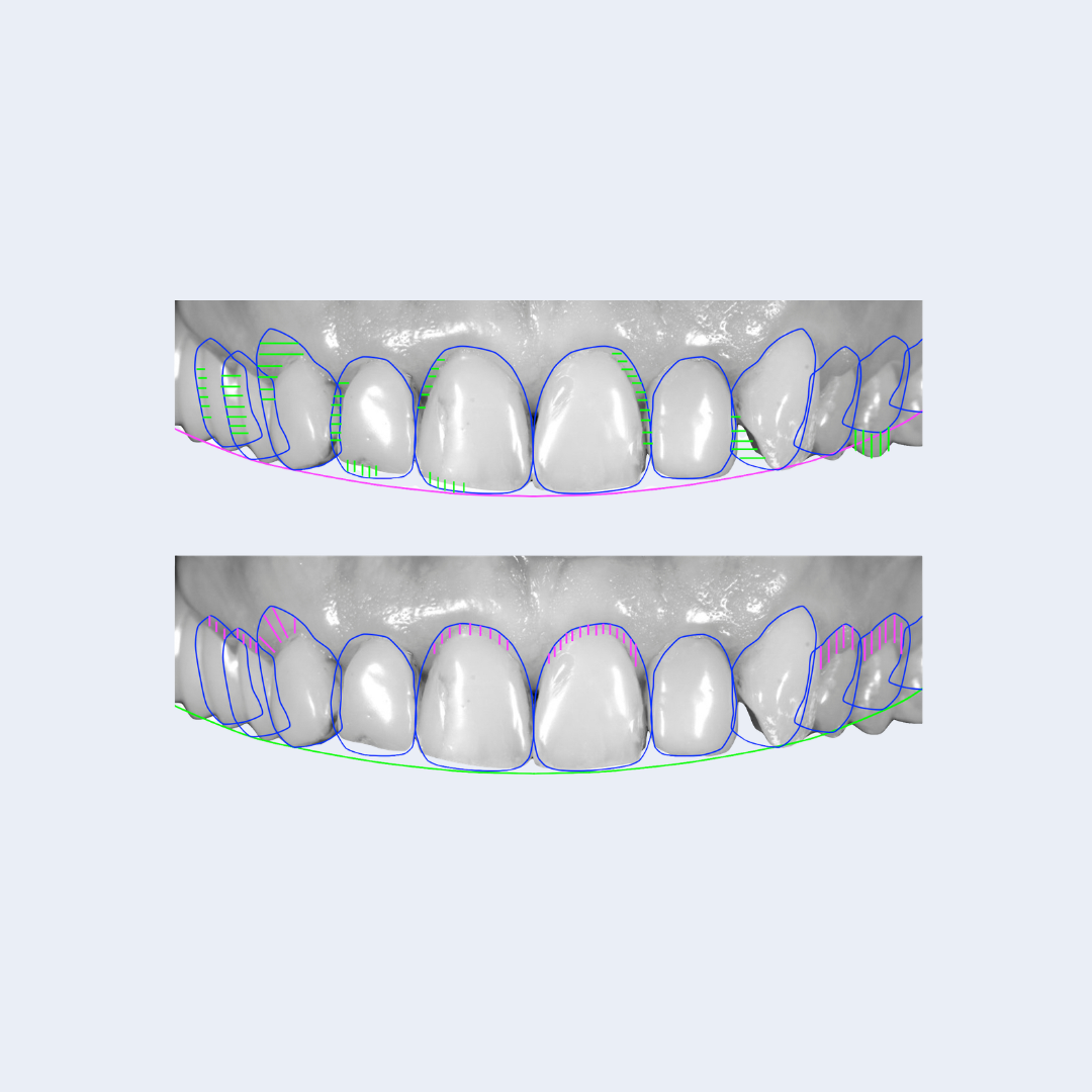 Diagnostic wax-up for treatment planning